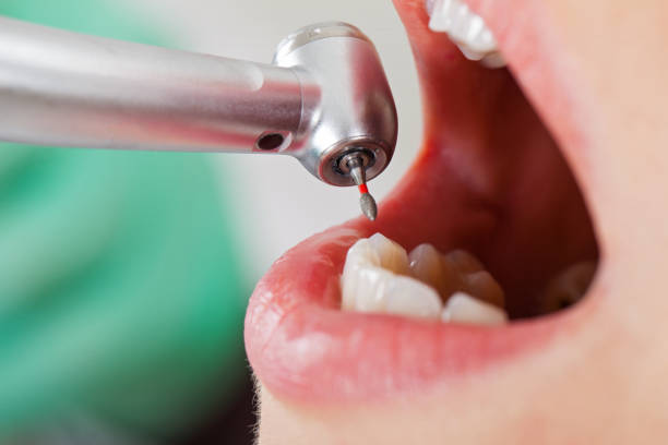 Best Emergency Wisdom Teeth Removal in Bethany, IL